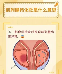 前列腺钙化