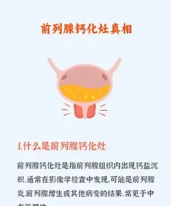 前列腺钙化灶